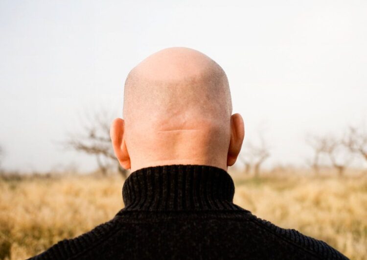 أين يتواجد أكثر الصلعان في دول العالم